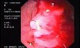 Adenoarcinoma Of The Ascending Colon (3 of 3)