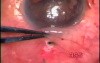 Juvenile glaucoma with aniridia and microcornea - surgery with use Fugo Blade