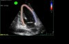 Overloading Of The Heart In Echocardiography