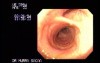 Endoscopic Assessment of Tracheal Bifurcation