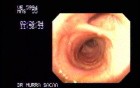 Endoscopic Assessment of Tracheal Bifurcation