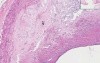 Atherosclerosis - Histopathology - Coronary arteries