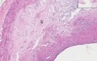 Atherosclerosis - Histopathology - Coronary arteries