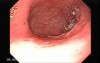 Endoscopy of gastric cancer