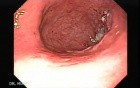 Endoscopy of gastric cancer