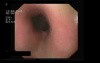 Stage I Of Esophageal Varices 