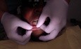Orthodontic Case #3 - Mesialize Maxillary Posterior Segment W/ Class 3 Elastics