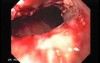 Synchronous Cancer (Gastric and Esophageal) - Visualization of the Malignancy of the Middle Third of Esophagus