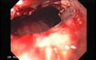 Synchronous Cancer (Gastric and Esophageal) - Visualization of the Malignancy of the Middle Third of Esophagus