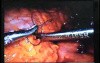 Jejunal Gastrointestinal Stromal tumor (GIST) (63 of 86)