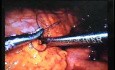 Jejunal Gastrointestinal Stromal tumor (GIST) (63 of 86)