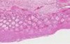 Pseudomembranous Colitis