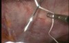 Laparoscopic ventral hernia repair