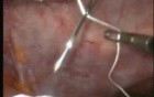 Laparoscopic ventral hernia repair