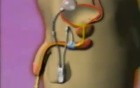 Artificial Urinary Sphincter - Animation