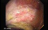 Severe case of Ischemic Colitis (5 of 19)