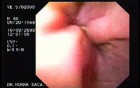 Acute Variceal Bleeding - Necrotic Varices After Ligation, Part 3
