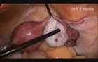 Laparoscopic Tubal Patency Test and Ovarian Drilling