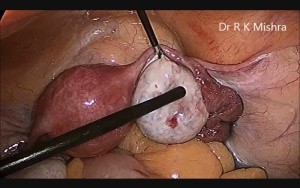 Laparoscopic Tubal Patency Test and Ovarian Drilling