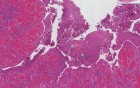 Crohn disease - Histopathology - Small intestine