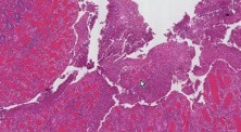 Crohn disease - Histopathology - Small intestine