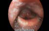 The Typical Laryngeal Endoscopy Appearance in Reflux Laryngitis