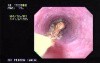 Polypectomy Snare in Non-typical Usage - 76 Years-Old Man