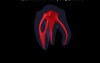 Mandibular Second Molar - Radix