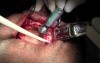 Flap Design & Osteotomy Preps - Implant Surgery, #10-11-12-13 Sites