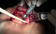 Flap Design & Osteotomy Preps - Implant Surgery, #10-11-12-13 Sites