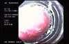 Banding of esophageal varices (5 of 17)