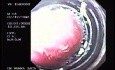 Banding of esophageal varices (5 of 17)