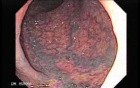 Diffuse Colonic Varices (2 of 4)