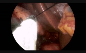 Laparoscopic Single Incision Cholecystectomy