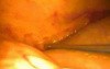 Laparoscopic reoperative biliary surgery