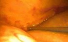 Laparoscopic reoperative biliary surgery
