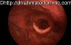 Functional Aphonia - laryngeal movements 