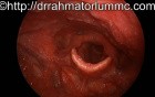 Functional Aphonia - laryngeal movements 