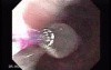 Colonic Interposition for Esophageal Substitution (3 of 11)