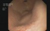 Chronic HP Infection Lymphoid Antral Hyperplasia 