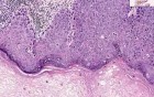 Carcinoma in situ - Histopathology of penis