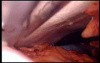Colonic Perforation With Peritonitis - Laparoscopy (43 of 46)