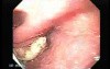 Esophageal Squamous Cell Carcinoma of the the upper third of the Esophagus that invades the subglotic (3 of 8)