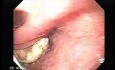 Esophageal Squamous Cell Carcinoma of the the upper third of the Esophagus that invades the subglotic (3 of 8)