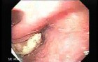 Esophageal Squamous Cell Carcinoma of the the upper third of the Esophagus that invades the subglotic (3 of 8)