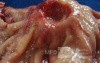 Diffuse Adenocarcinoma with signet ring cells (4 of 18)