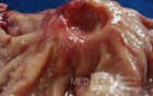 Diffuse Adenocarcinoma with signet ring cells (4 of 18)