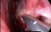Inferior Turbinate Submucous Resection (SMR)