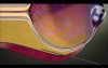 Sub-Tenon Injection