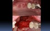 Socket Grafting 101 Part A